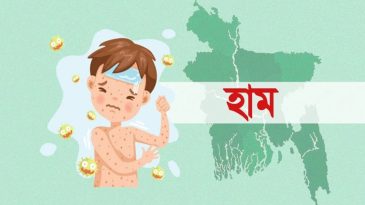সিলেটে হাম উপসর্গে প্রাণ গেল আরেক শিশুর