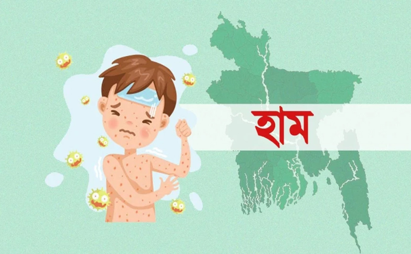 সিলেটে হাম উপসর্গে প্রাণ গেল আরেক শিশুর
