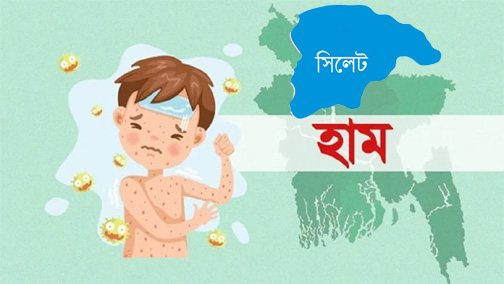 সিলেটে হামের উপসর্গে প্রাণ গেলো আরেক শিশুর